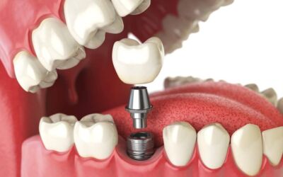 Implante Dentário na Barra da Tijuca: Como é a cirurgia de implantes?