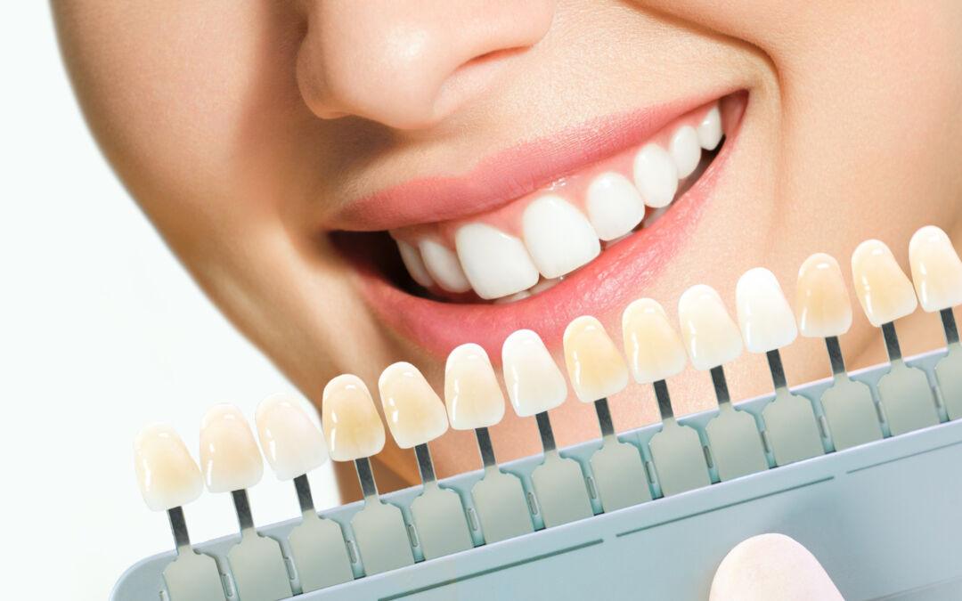 Clareamento Dental: Mitos e Verdades