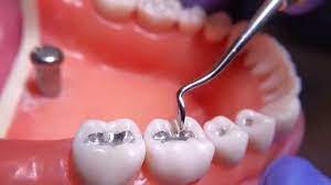 Obturação no dente: o que é, para que serve e como é feita