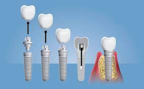 Tipos de implante dentário: conheça quais são eles!